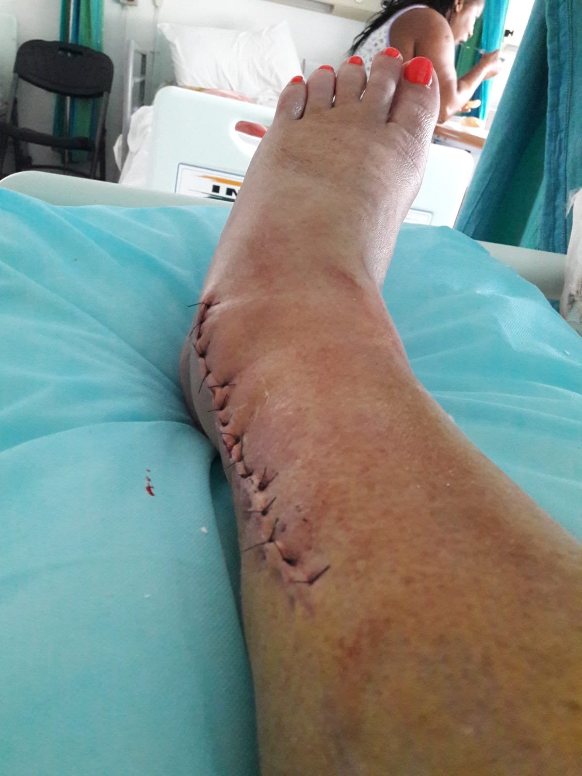 Noha po operaci
